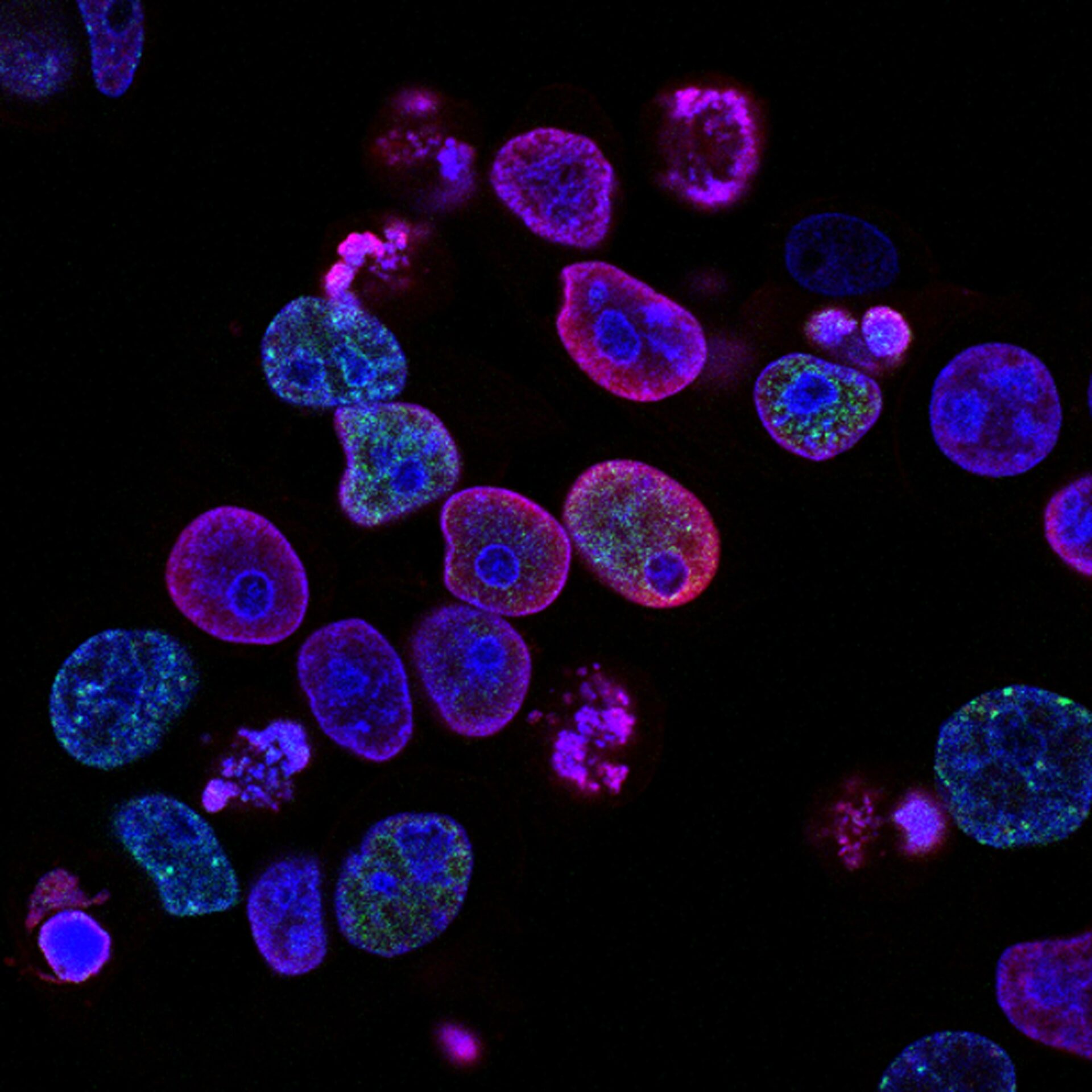 Ai in cancer treatment