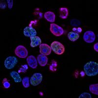 Ai in cancer treatment
